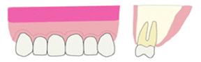 歯茎の縫合